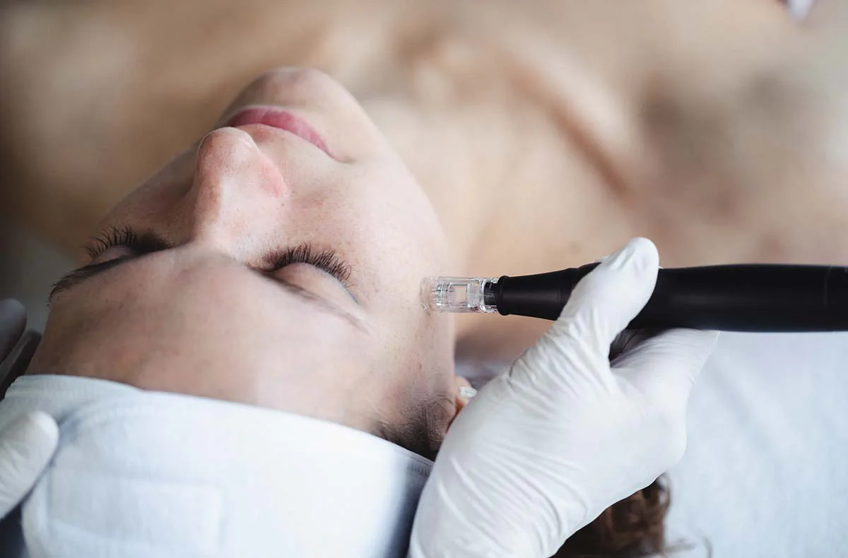 Microneedling Düsseldorf (60 Min.) - 2